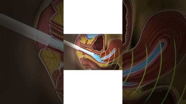 How follicles and eggs are viewed? Dr Rhythm Gupta - IVF Specialist, at Excel IVF смотреть онлайн