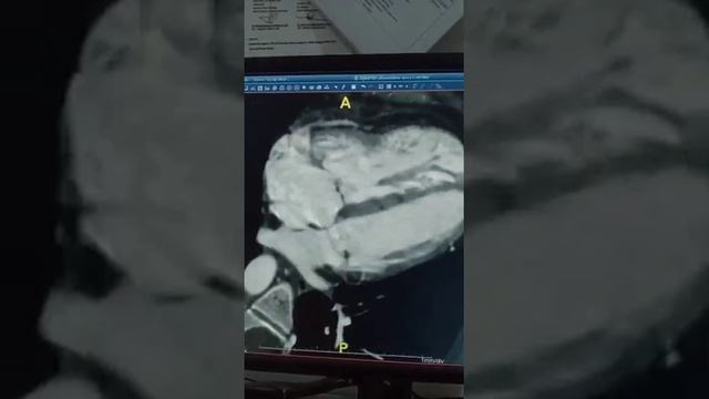Patent Foramen Ovale смотреть онлайн