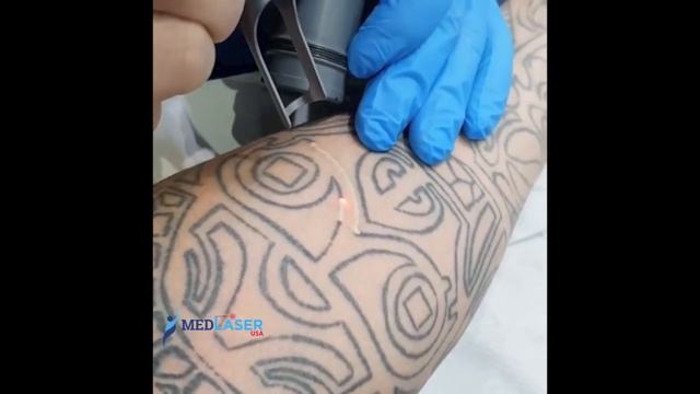 Lucid Q PTP Laser System - Laser Tattoo Removal смотреть онлайн