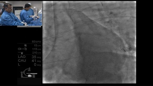 PCI of LAD, LCX & RCA lesions (IVUS guided) смотреть онлайн