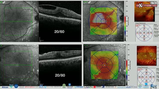 RetinaExtrema - Modulo 4 - FacoExtrema 2019 смотреть онлайн