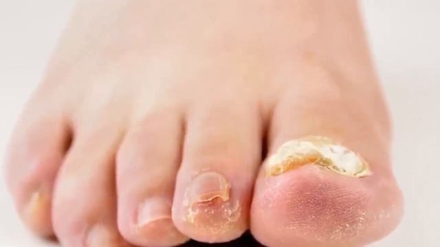 This Mixture Will Destroy The Fungus On The Legs and Hands Instantly! Amazing Effect! смотреть онлайн