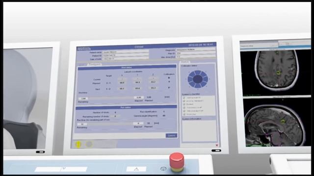 What is the Gamma Knife Video смотреть онлайн
