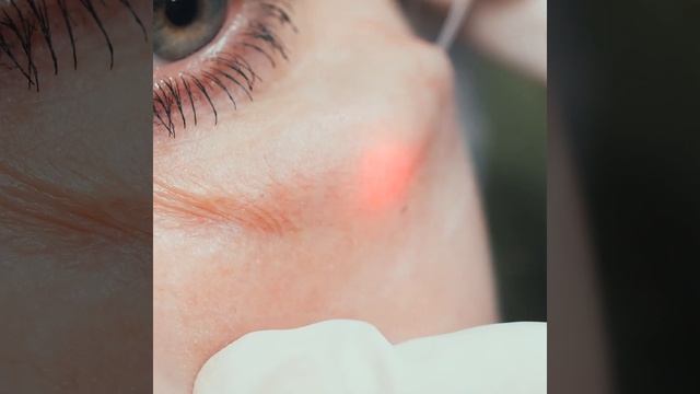 Ендоліфтінг | Эндолифтинг | Лифтинг лица |   Подтяжка лица |  Лазерная медицина Харьков