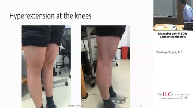 Dr. Pradeep Chopra, MD | Managing pain in EDS: Connecting the Dots Part 2 смотреть онлайн