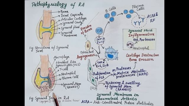 Pathophysiology And Pathogenesis Of Rheumatoid Arthritis | Dr. Shikha Parmar
