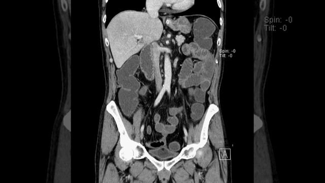 CT abdomen coronal смотреть онлайн
