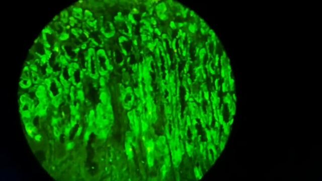 Parietal cell antigens detection by indirect immunofluorescence for diagnosed Autoimmune gastritis смотреть онлайн