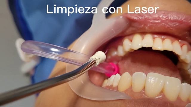 Limpieza Dental con Láser смотреть онлайн