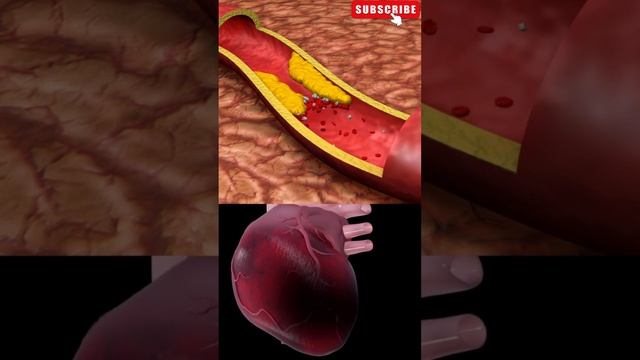 Colesterol LDL (“Colesterol ruim”) смотреть онлайн