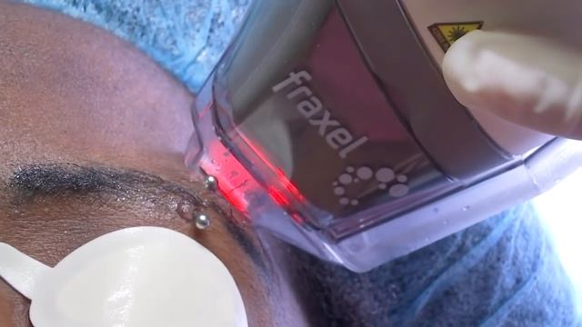 Brown and Black Skin Laser Treatment смотреть онлайн