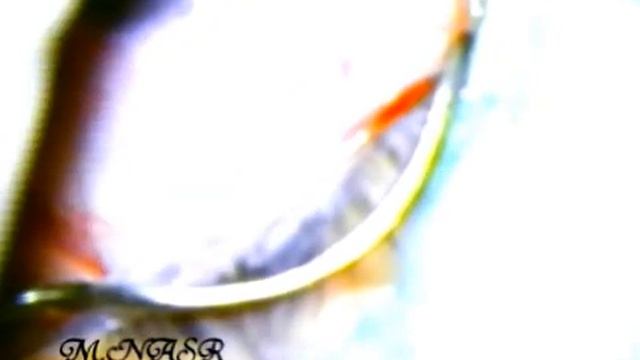 SUTURLESS PTERYGIUM SURGERY