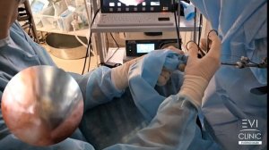 Офисная гистероскопия