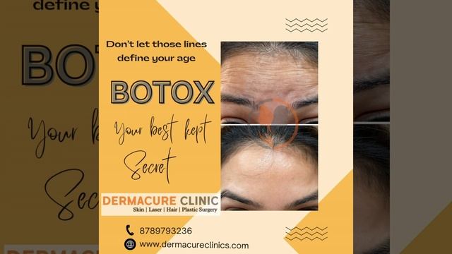 BOTOX forehead crowsfeet frownlines finewrinkles necklift смотреть онлайн