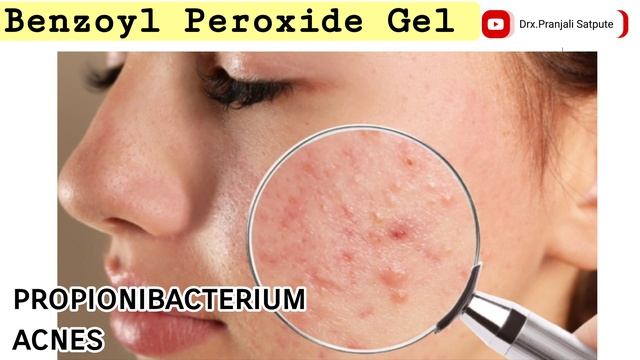 Benzoyl Peroxide Gel 2.5 How To Use | Persol ac 2.5 gel | Pimple Acne ka ilaj | Pranjali Satpute смотреть онлайн