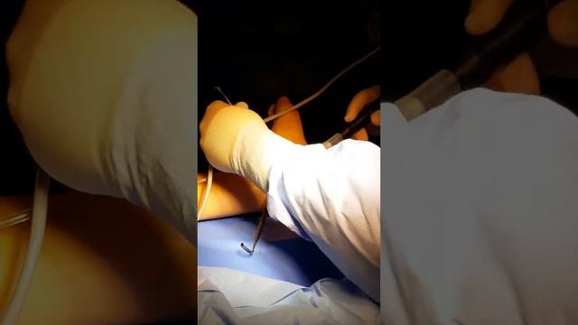 Misonix ultrasonic bone scalpel Dr Wrotslavsky смотреть онлайн