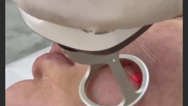 Salutem Dermatoloji Klinika / Çapığın Erbium lazer və Co2 fraksional lazer vasitəsi ilə müalicəsi смотреть онлайн