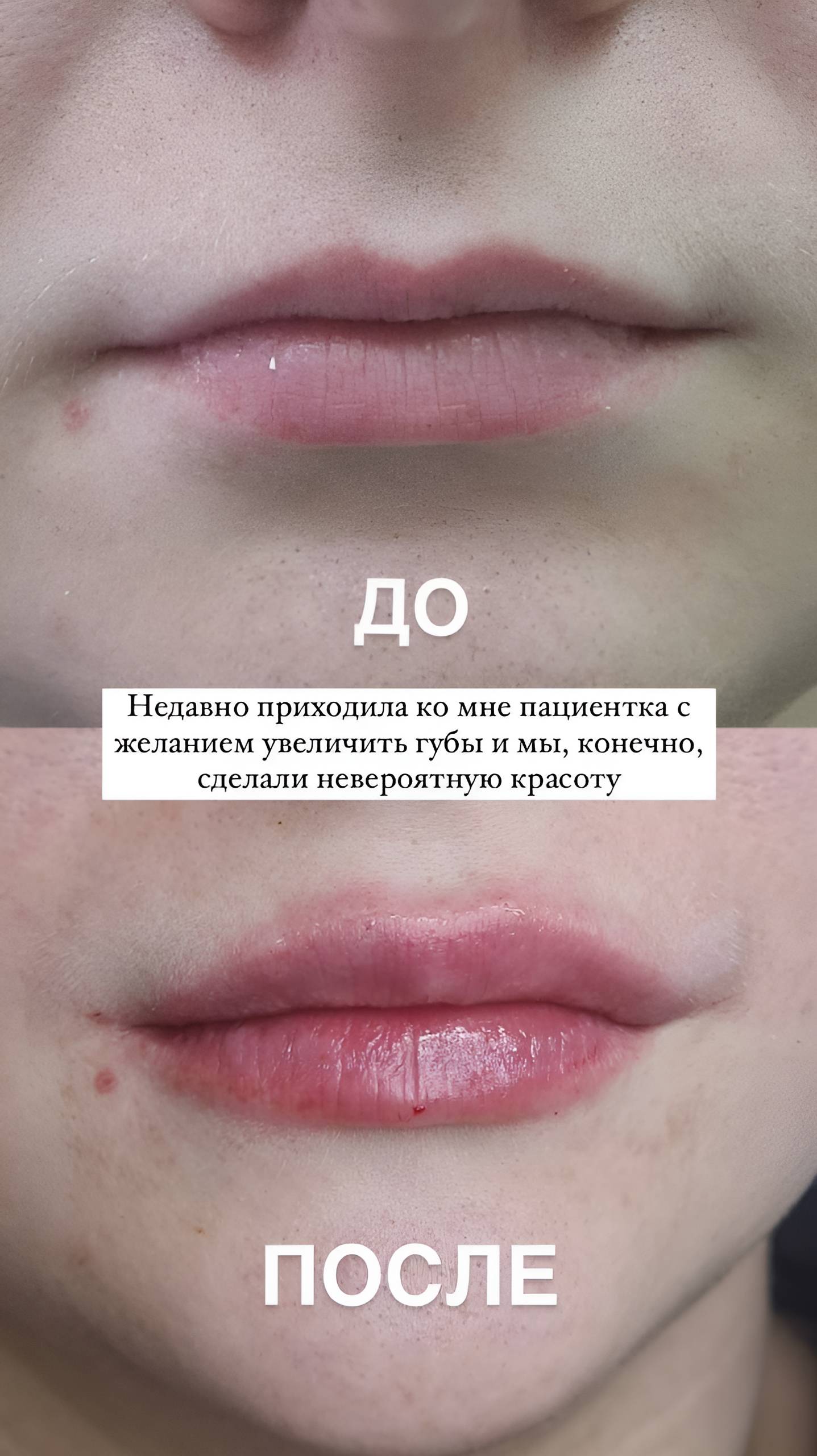 Коррекция губ, как увеличивают губы