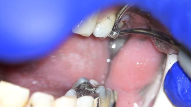 Cast Post Removal - Double piezo Ultrasonics смотреть онлайн