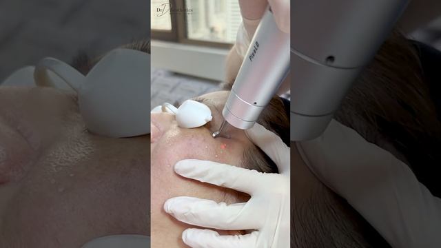 Does PICO Laser only treat pigmentation？｜DR D AESTHETICS CLINIC SINGAPORE смотреть онлайн