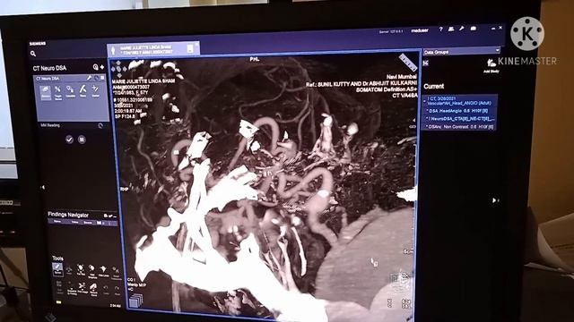 CT BRAIN and Neck Angiogram, full process on Siemens Syngo workstation смотреть онлайн