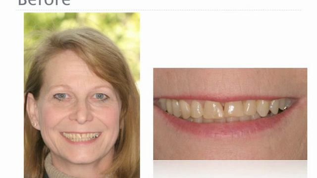 Dental Masters Laboratory e.max CAD, e.max Press, and Empress Esthetic Case Studies смотреть онлайн