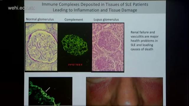 Tarlinton (2016): On the immunology of autoimmunity смотреть онлайн