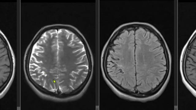 mri brain Trigeminal schwannoma смотреть онлайн