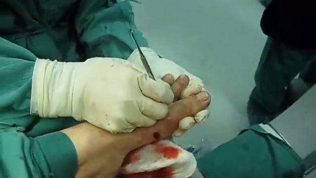 JUANETES CIRUGIA PERCUTANEA DEL PIE смотреть онлайн