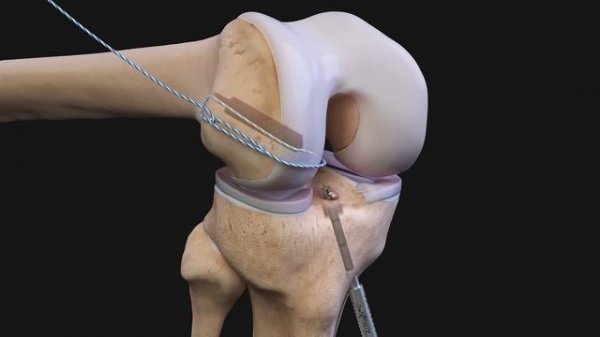 Arthrex ACL Reconstruction