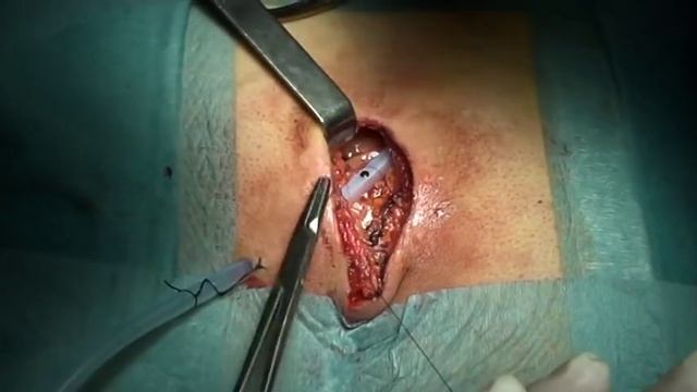 Metodica operatoria di fistola sacro-coccigea ed applicazione di gel piastrinico смотреть онлайн