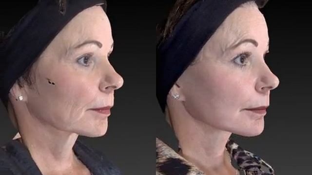 Facial Rejuvenation 3D Before and After-05 смотреть онлайн