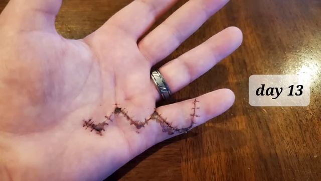 hand surgery healing- time lapse. 36 days in 90 seconds. смотреть онлайн