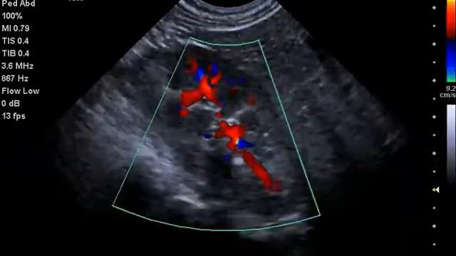Low flow colour Doppler using the 11M3 microconvex probe on Siemens Acuson P500 - paediatric kidney смотреть онлайн