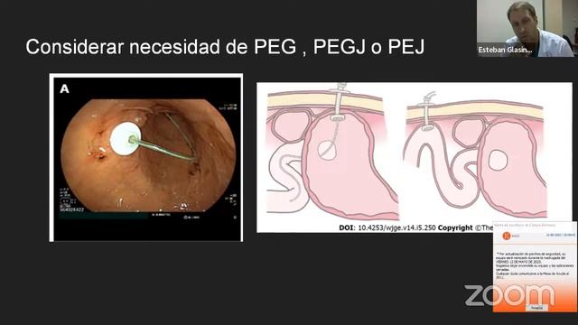 Neurogastro: Compromiso gastrointestinal en enfermedad de Parkinson смотреть онлайн