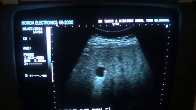 SIMPLE LIVER CYST смотреть онлайн