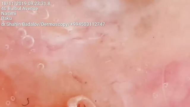 Bazalioma.BCC. Базалиома