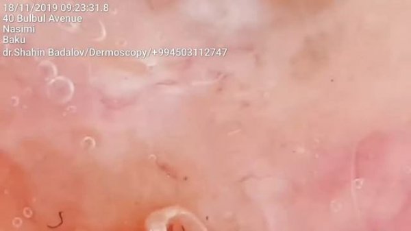 Bazalioma.BCC. Базалиома