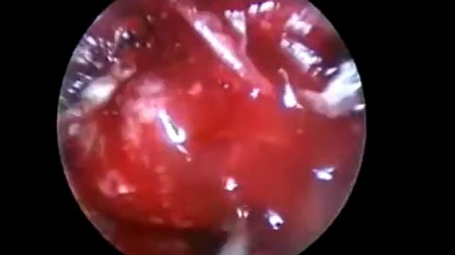 Pituitary Adenoma (Case 2) смотреть онлайн