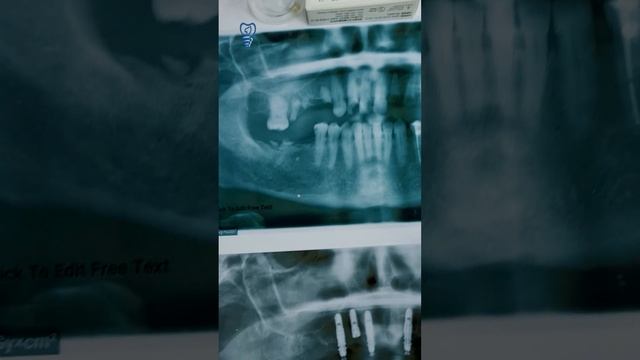 Удаление 11 зубов, киста и 7 имплантатов. История пациента по ссылке на экране. Имплантация зубов. смотреть онлайн