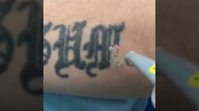 УДАЛЕНИЕ ЛАЗЕРОМ ТАТИРОВОК по запис:+99890 3944334 смотреть онлайн