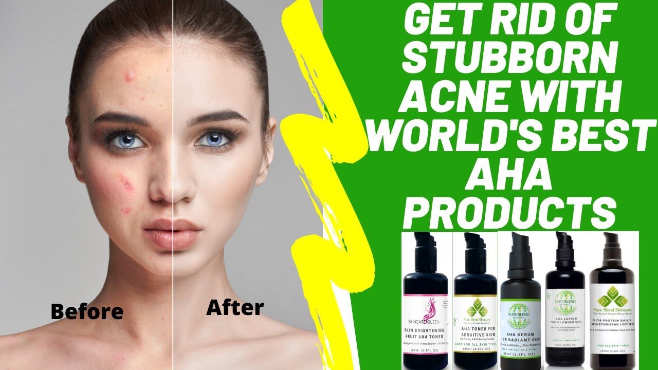 How To Get Rid Of Stubborn Acne Breakout & Pimples With World's Best AHA Products смотреть онлайн