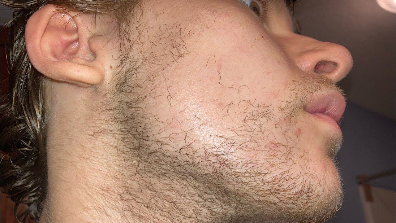 Minoxidil and Derma roller (Week 42) (Month 10) смотреть онлайн