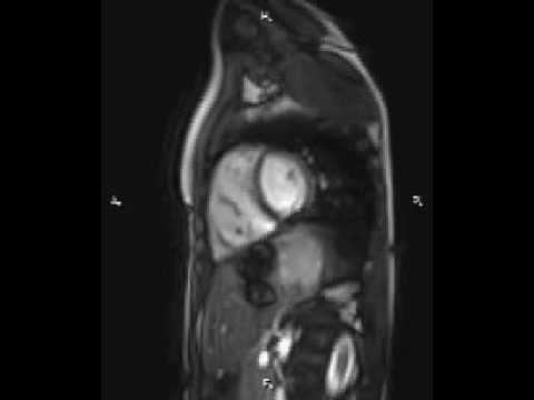 мрт сердцу ребенка с тяжелой патологией тетрада Фалло смотреть онлайн