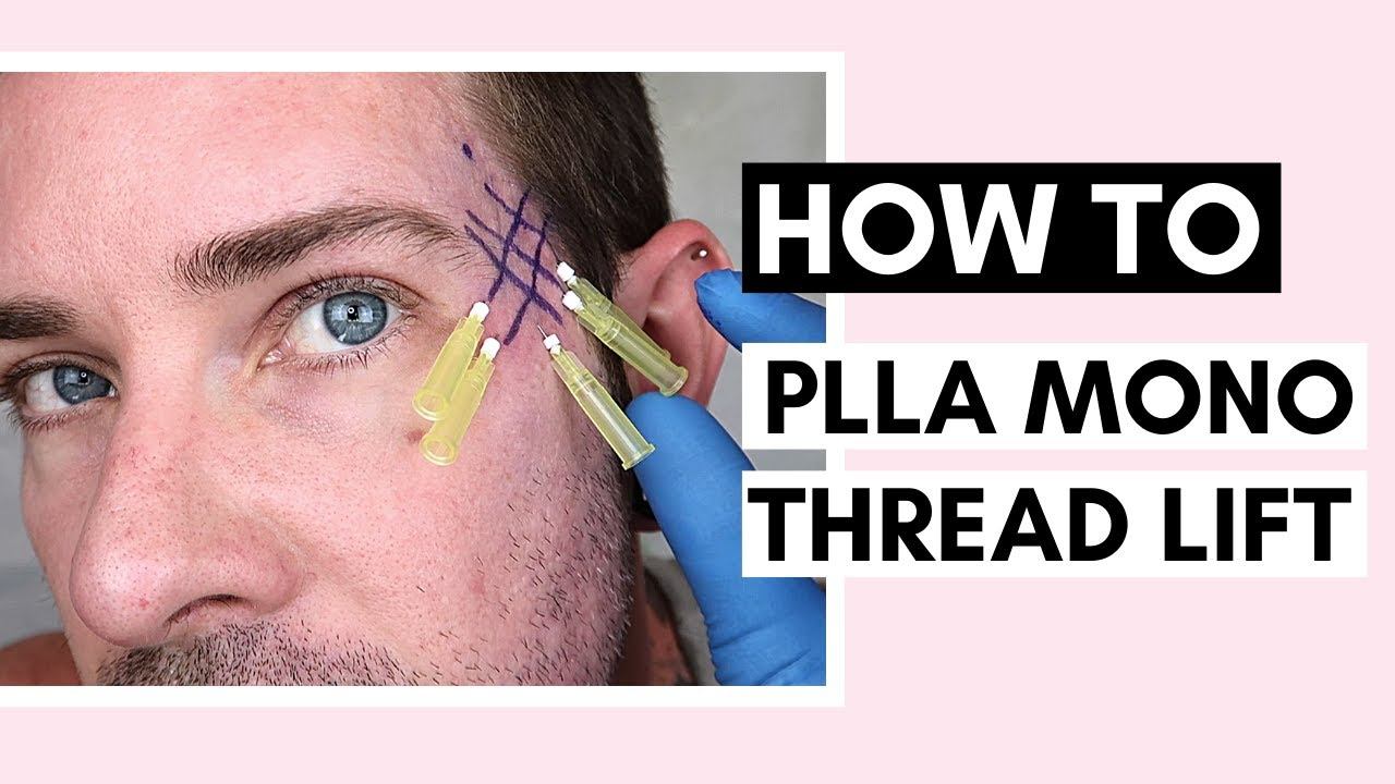 PLLA Mono Thread Lift On Temples | Technique, Tips & How To Insert Threads Ft @Vanidiy