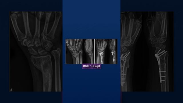 6 недель в гипсе это максимум! смотреть онлайн