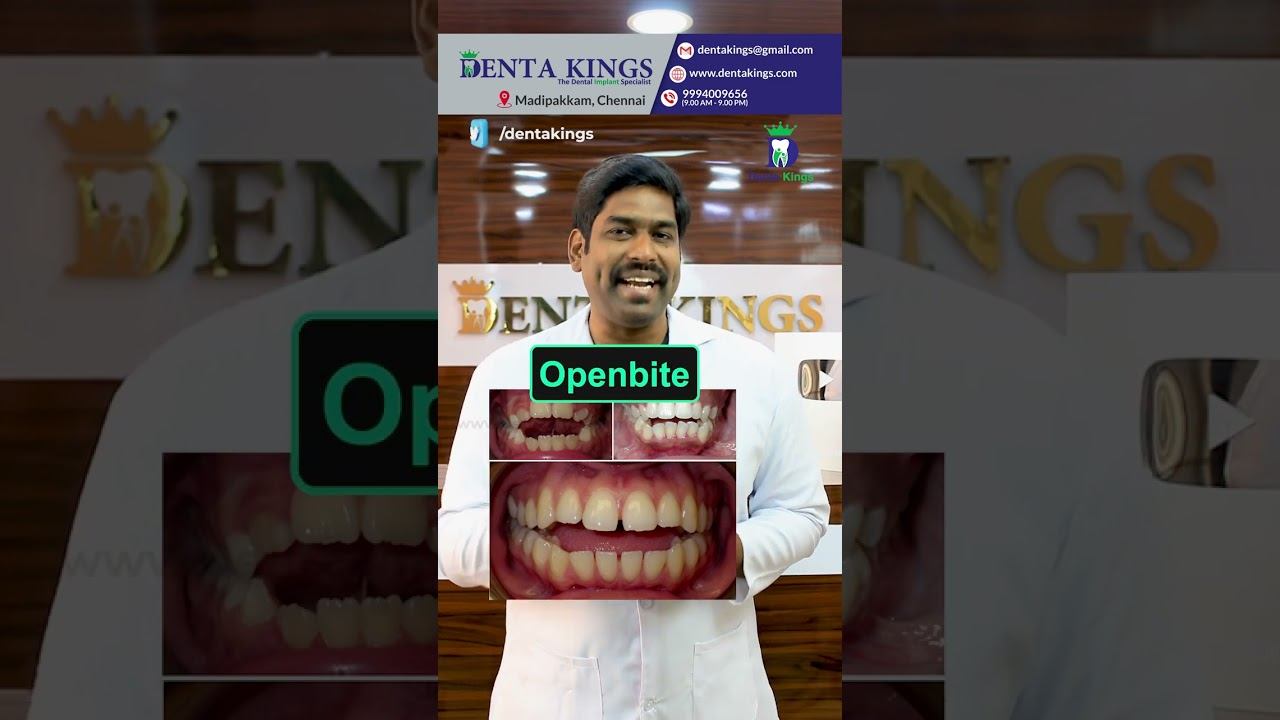 முன் பற்கள் சரியாக சேர்வதில்லையா? - Openbite in the Front Teeth | Denta Kings | Dr. Karthikeyan смотреть онлайн