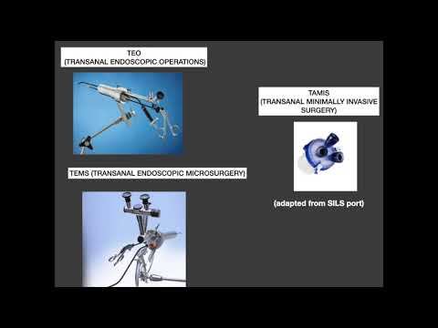 Trans-anal Minimally Invasive Surgery (TAMIS) смотреть онлайн