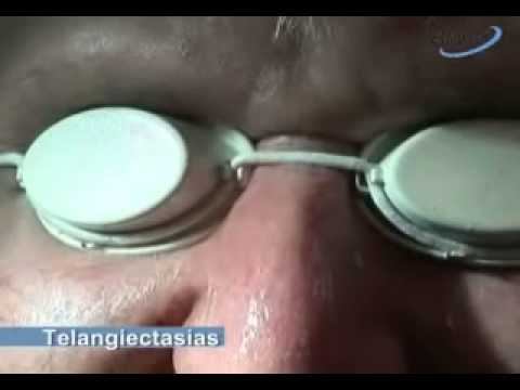 Ellipse 3B Telangiectasias Treatment смотреть онлайн