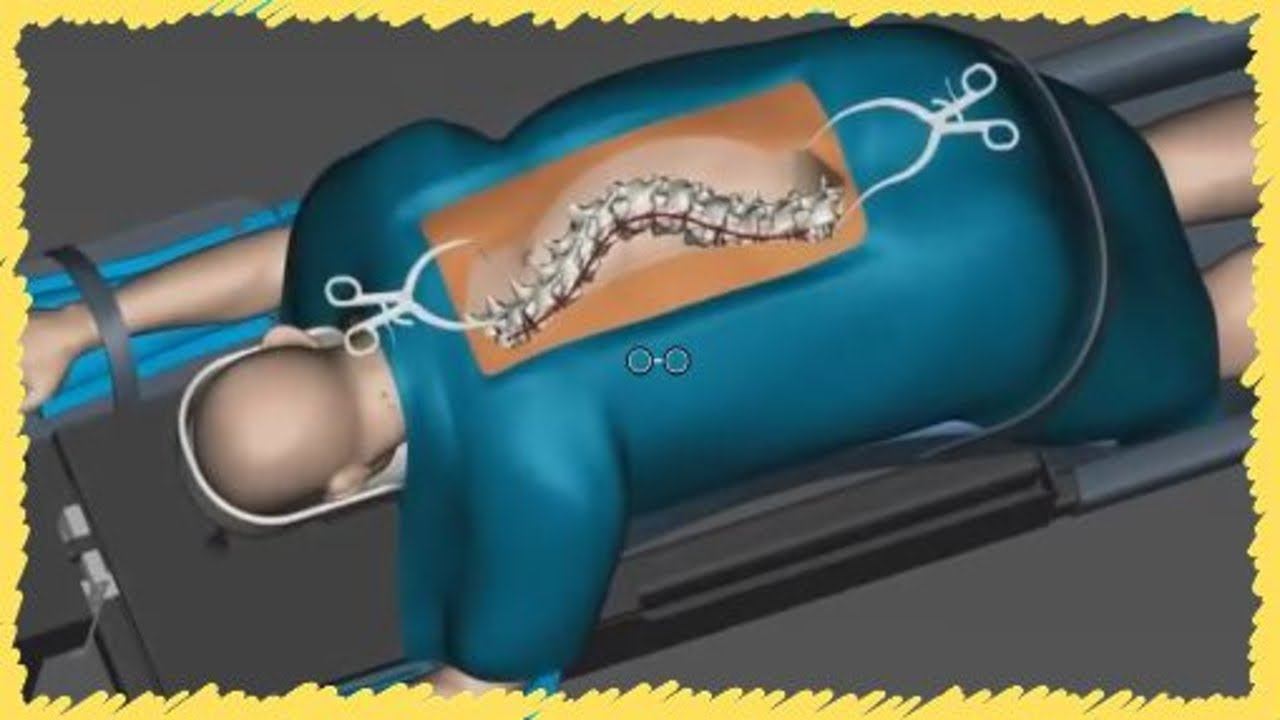 Aprende Corrección de Escoliosis || Animación 3D смотреть онлайн